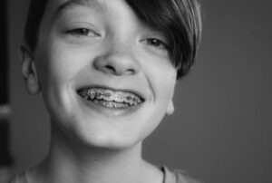 Dental Braces Price in South Africa
